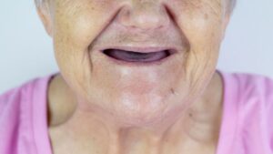 Lower half of edentulous person’s face 
